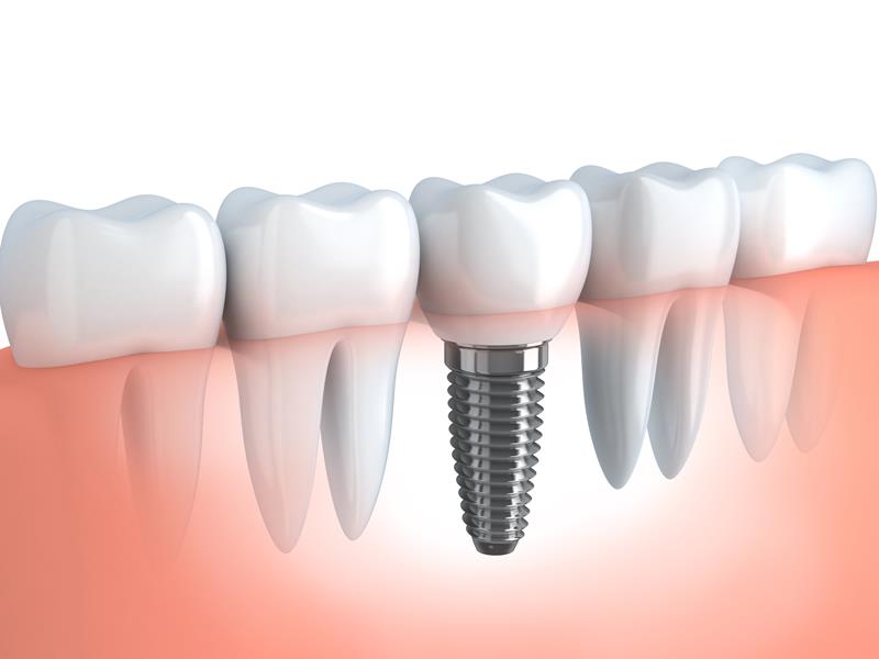 Dental Implants Alton, IL 